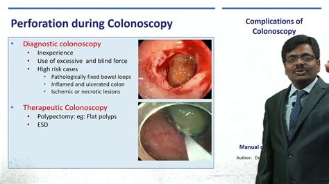 Complications in Colonoscopy - YouTube