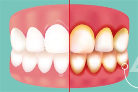 Symptoms and Treatment of Gingivitis | Shervin M. Louie, DDS