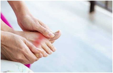 Colchicine vs Allopurinol - Which Is Better For Gout Treatment? - Your ...