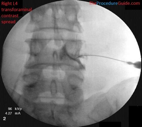 Fluoroscopic Guided Thoracic/Lumbar Transforaminal Epidural, 41% OFF