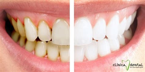 ¿Quieres hacerte un blanqueamiento dental casero? Primero infórmate bien