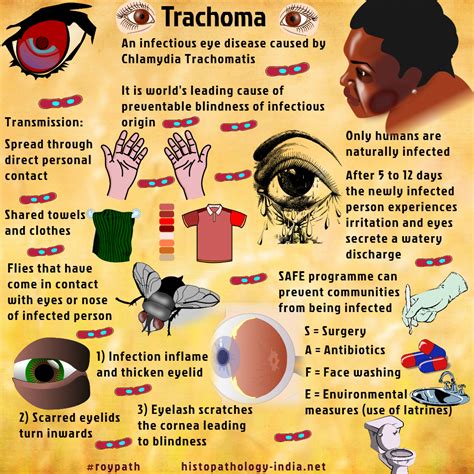 Pathology of Trachoma | Poor personal hygiene, Pathology, Medical school inspiration