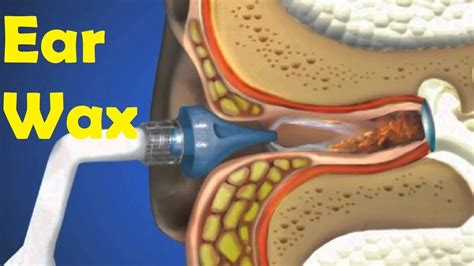 How To Remove Built Up Earwax At Home at Juanita Nystrom blog