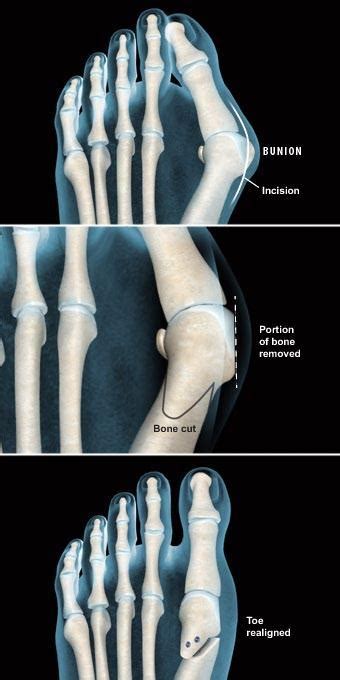 Bunionectomy (Chevron Bunionectomy) - Houston, TX: Spring Branch ...