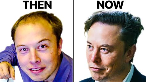 Elon Musk's Hair Transplant | Surgeon Reacts :: GentNews