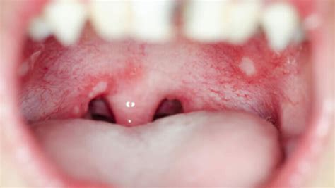 White Spots On Throat: Causes And Treatments - Aether Health - Kingwood ER