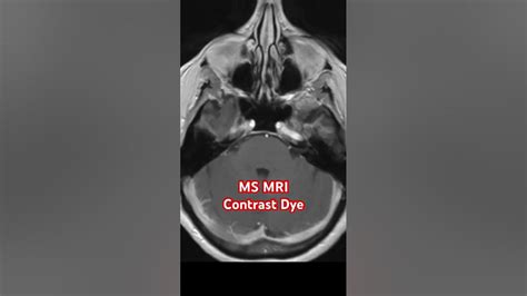 MS MRI Contrast Dye - YouTube