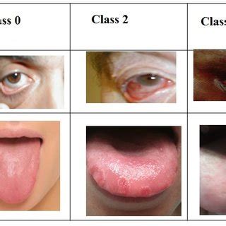 Anemia Lower Eyelid