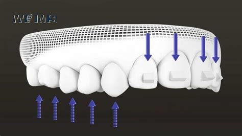 Invisalign Attachments: What are they and how do they work? - WOMS