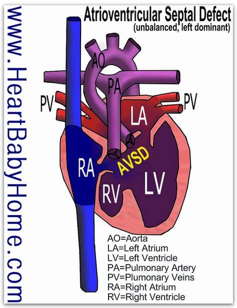 Atrioventricular Canal Defect