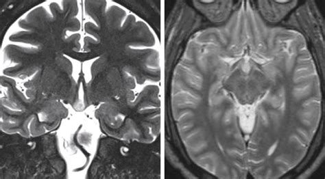 Hypothalamic Hamartoma | The Neurosurgical Atlas