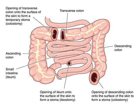 Diverting Loop Ileostomy