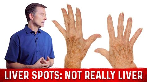 Liver Spots Causes