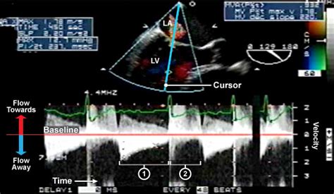 Virtual Transesophageal Echocardiography