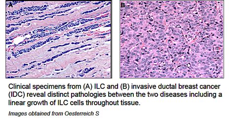 Expert Opinion: Imaging and Lobular Breast Cancer - The Lobular Breast Cancer Alliance