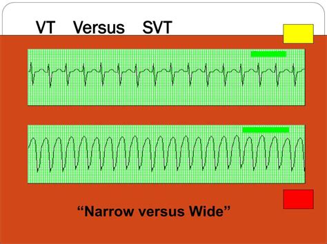 PPT - Cardiovascular--- EKG’s / Cardiac Monitoring PowerPoint Presentation - ID:2350898