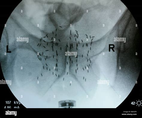 prostate implant of radioactive iodine seeds in the prostate treating prostate cancer seed ...