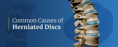 What Causes a Herniated Disc? | Spine INA | New Jersey