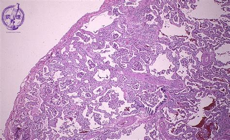 Interstitial Pneumonia Histology