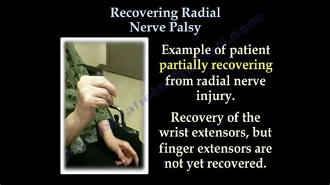 Radial Nerve Palsy ,Recovering . Part II- Everything You Need To Know - Dr. Nabil Ebraheim - YouTube