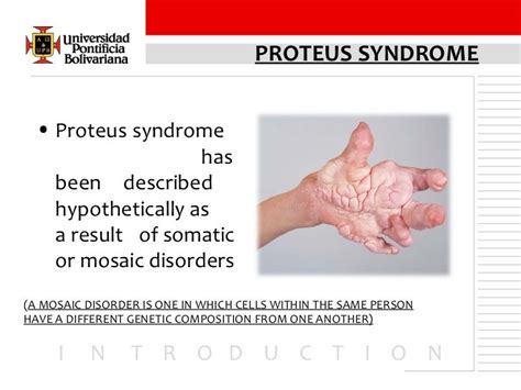 Proteus Syndrome Seminar