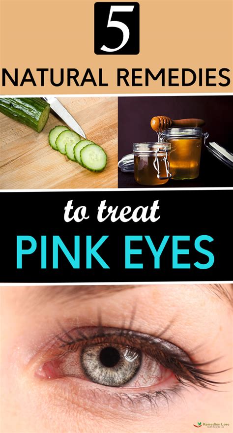 5 Natural Remedies To Treat Pink Eyes - Remedies Lore