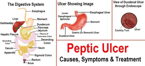 Peptic Ulcer Disease System Disorder Template