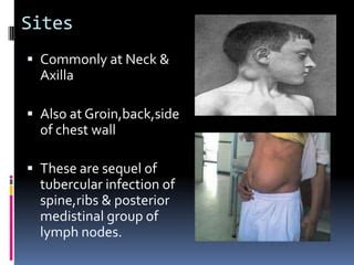 Cold abscess | PPT