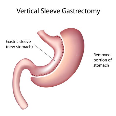 Sleeve gastrectomie operatie - Chirurgie Waregem