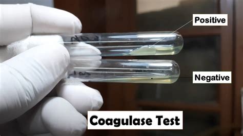 Tube Coagulase Test Positive and Negative for Staphylococcus aureus and CoNS Identification ...