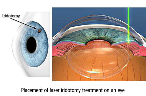 Laser Iridotomy And Narrow Angles - Glaucoma Research Foundation