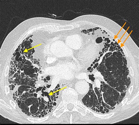 Honeycombing and traction bronchiectasis - Radiology at St. Vincent's University Hospital