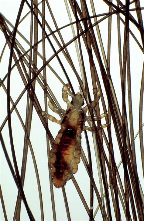 Head Louse In Human Hair Photograph by George Bernard/science Photo Library