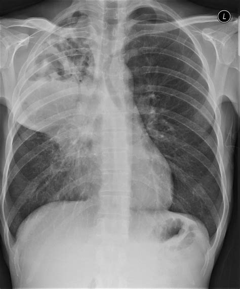 Lung abscess definition, causes, symptoms, diagnosis & treatment