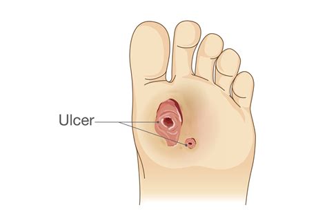 How to Prevent and Treat Diabetic Foot Ulcers - MVS Podiatry Associates