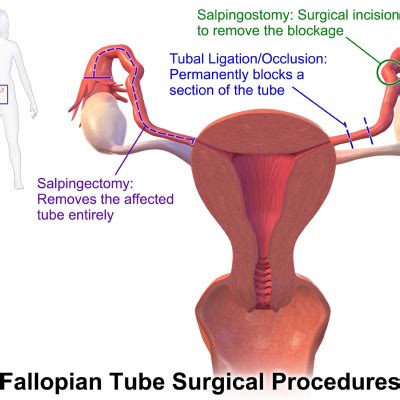 Laparoscopic Tubectomy - SANJAY HOSPITAL