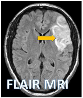 Broca's Aphasia & Stroke - Sumer's Radiology Blog