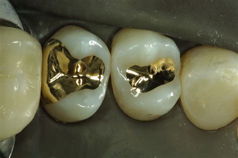 Updates in Dental Excellence: Gold Inlay Examples on My Happy Patients