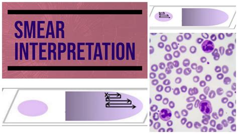 Peripheral smear - Interpretation #hematology #pathology #pathologylab #smear - YouTube