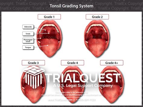 Tonsillitis Grading