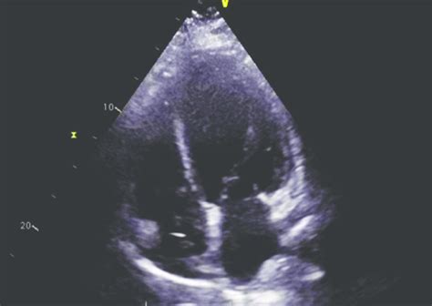 TTE image demonstrating a pattern of global hypokinesis. | Download Scientific Diagram