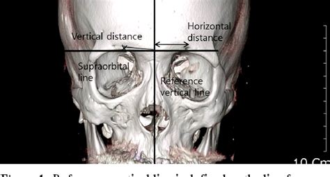 Figure 1 from Anatomical Location and Distribution of Supraorbital Notch and Foramen Evaluations ...