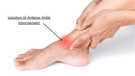 Anterior Ankle Impingement: Symptoms, Causes and Treatment