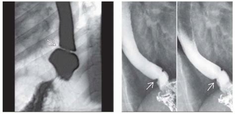 Schatzki Ring | Radiology Key