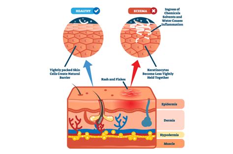 Common Causes and Triggers of Eczema | Stoner Symphony