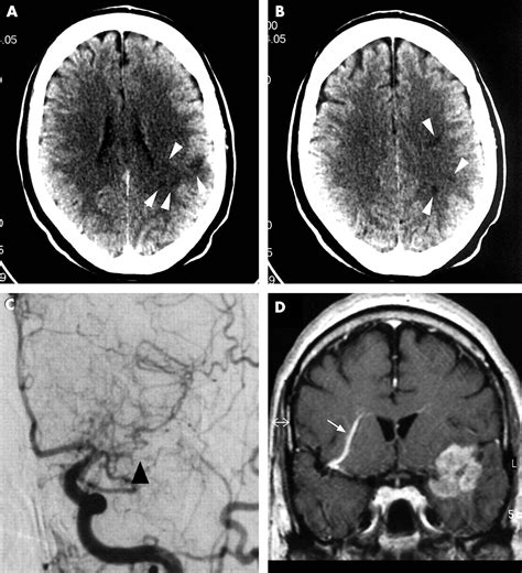 A case of gliosarcoma appearing as ischaemic stroke | Journal of ...