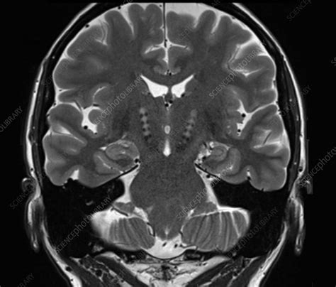 Parkinson's disease, MRI scan - Stock Image - C052/8787 - Science Photo Library