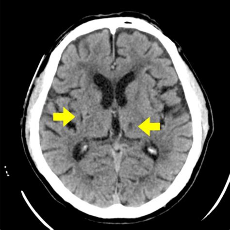 Incidental finding of persistent trigeminal artery in a patient with ...