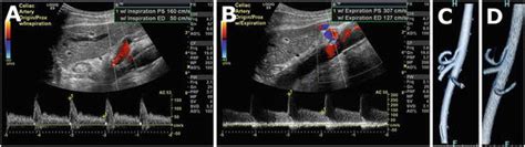 Duplex Ultrasound of the Mesenteric Vessels | Thoracic Key