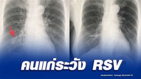 RSV Outbreak: Elderly Beware - Tips and Warnings from Dr. Manoon ...